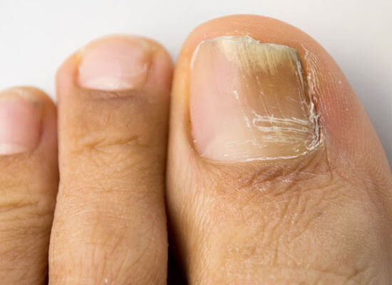 Nagelpilz / FungiCheck