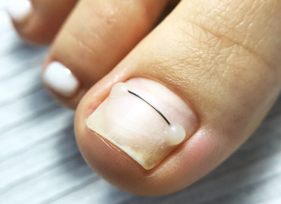 Orthonyxie / Nagelspange