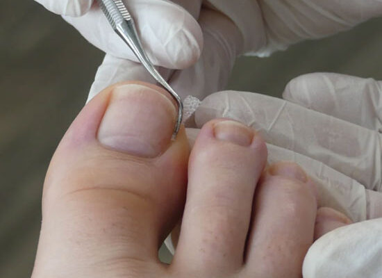 Podologische Teilbehandlung